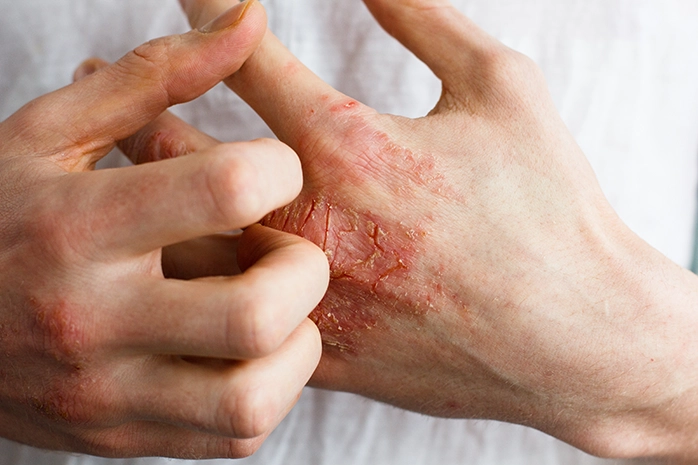 L'eczéma peut être soigné par un coupeur de feu