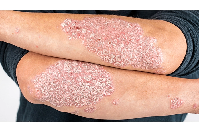 Le psoriasis peut être soigné par un coupeur de feu