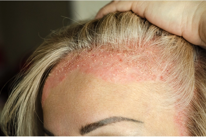 Le psoriasis capillaire peut être soigné par un coupeur de feu